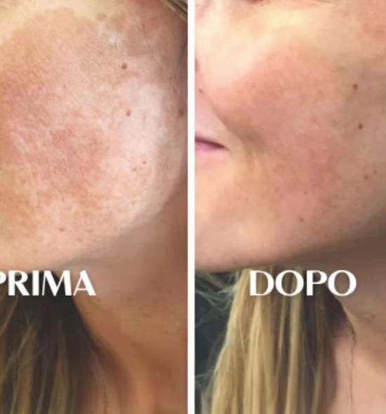 prima-e-dopo-fotobiostimolazione